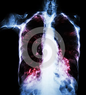 Pulmonary Tuberculosis ( film chest x-ray : interstitial infiltrate both lung due to Mycobacterium tuberculosis infection )