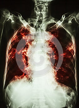 Pulmonary Tuberculosis . film chest x-ray of old patient show interstitial infiltration both lung and calcification at trachea c