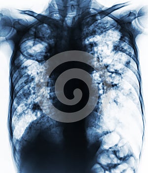 Pulmonary Tuberculosis . Film chest x-ray show fibrosis,cavity,interstitial infiltration both lung due to Mycobacterium tuberculos