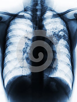 Pulmonary Tuberculosis . Film chest x-ray show alveolar infiltrate at left middle lung due to Mycobacterium tuberculosis infection