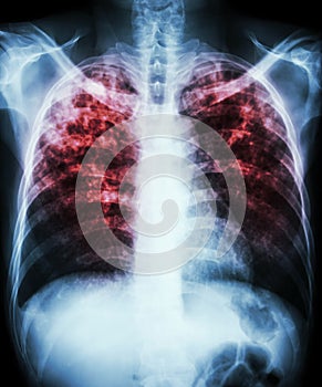 Pulmonary tuberculosis photo