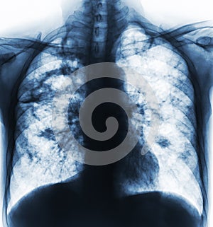 Pulmonary tuberculosis . Film x-ray of chest show cavity at right lung and interstitial infiltrate both lung due to TB infection