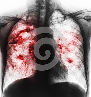 Pulmonary tuberculosis . Film x-ray of chest show cavity at right lung and interstitial infiltrate both lung due to TB infection photo