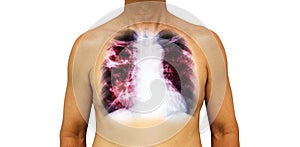 Pulmonary tuberculosis . Human chest with x-ray show cavity at right upper lung and interstitial infiltrate both lung due to infec