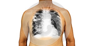 Pulmonary tuberculosis . Human chest with x-ray show cavity at right upper lung and interstitial infiltrate both lung due to infec