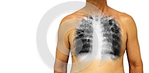 Pulmonary tuberculosis . Human chest with x-ray show interstitial infiltrate both lung due to infection . Isolated background . Bl