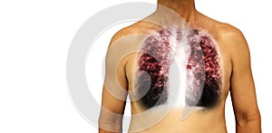 Pulmonary tuberculosis . Human chest with x-ray show interstitial infiltrate both lung due to infection . Isolated background . Bl