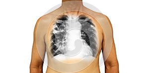 Pulmonary tuberculosis . Human chest with x-ray show cavity at right upper lung and interstitial infiltrate both lung due to infec photo