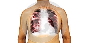 Pulmonary tuberculosis . Human chest with x-ray show cavity at right upper lung and interstitial infiltrate both lung due to infec