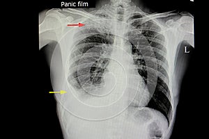 pulmonary tuberculosis with pleural effusion