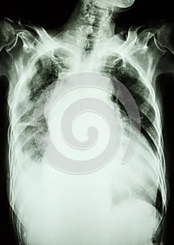 Pulmonary tuberculosis and right lung effusion photo