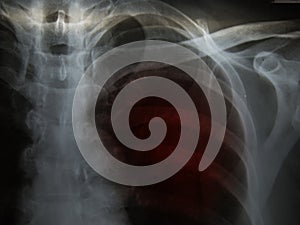 Pulmonary Tuberculosis TB : Chest x-ray show alveolar infilt