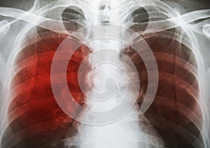 Pulmonary Tuberculosis TB : Chest x-ray show alveolar infilt