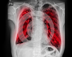 Pulmonary Tuberculosis TB : Chest x-ray show alveolar infiltration at both lung