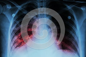 Pulmonary Tuberculosis ( TB ) : Chest x-ray show alveolar infiltration at both lung due to mycobacterium tuberculosis infection