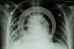 Pulmonary Tuberculosis ( TB ) : Chest x-ray show alveolar infiltration at both lung due to mycobacterium tuberculosis infection