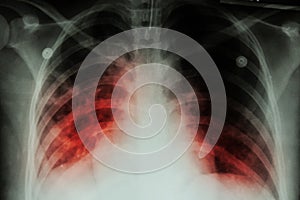 Pulmonary Tuberculosis ( TB ) : Chest x-ray show alveolar infiltration at both lung due to mycobacterium tuberculosis infectionP