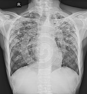 Pulmonary Tuberculosis TB : Chest x-ray