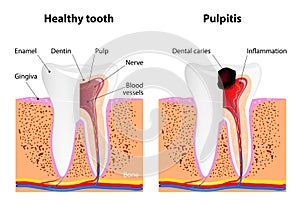 Pulpitis and Healthy tooth