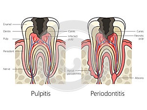 Pulpitis and periodontitis diagram medical science
