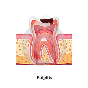Pulpitis Realistic Illustration