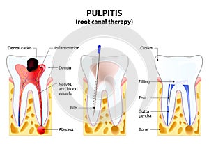 Pulpitis