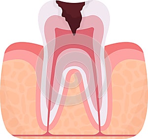Pulpitis Tooth Problem