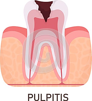 Pulpitis Tooth Problem