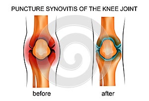 Puncture synovitis of the knee joint
