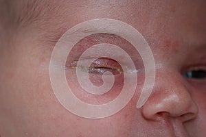 The purulent eye processed by tetracycline ointment Conjunctivitis, treatment of the newborn