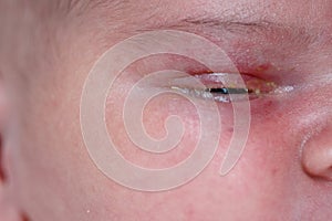 The purulent eye processed by tetracycline ointment Conjunctivitis, treatment of the newborn photo