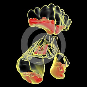 Purulent inflammation of frontal, maxillary, and ethmoid sinuses, close-up view