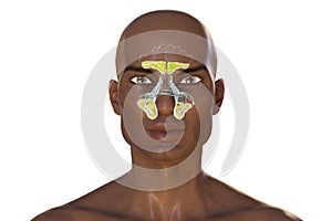 Purulent inflammation of frontal and maxillary sinuses in an African man