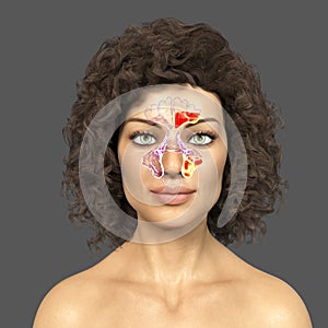 Purulent inflammation of maxillary and frontal sinuses in a female person photo