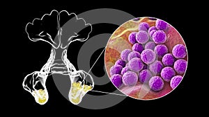 Purulent inflammation of maxillary sinuses and close-up view of bacteria Staphylococcus aureus that cause sinusitis