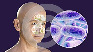 Purulent inflammation of right frontal sinus in a man and close-up view of bacteria that cause sinusitis