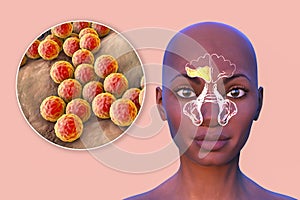 Purulent inflammation of right frontal sinus in a person and close-up view of bacteria Staphylococcus aureus that cause sinusitis