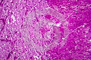 Purulent meningitis, light micrograph