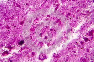 Purulent meningitis, light micrograph