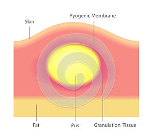 Pus and acne in skin vector