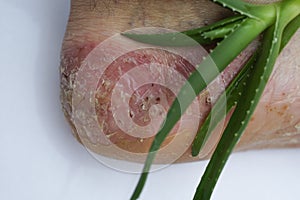 Pustular psoriasis lesions on the heel with an aloe plant photo