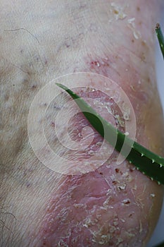 Pustular psoriasis lesions on the heel with an aloe plant photo