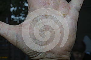 pustular psoriasis lesions on the left palm , Palmoplantar psoriasis, photo