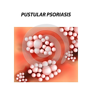 Pustular type psoriasis texture. Eczema, skin disease dermatitis. Infographics. Vector illustration on isolated