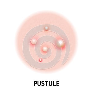 Pustule skin acne type vector icon. Skin disease acne pustules pimples type, face pore comedones