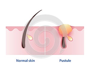 Pustule, type of inflammatory acne develop from papule vector on white background. photo