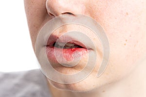 Pustule ulceration or aphtae on woman lip