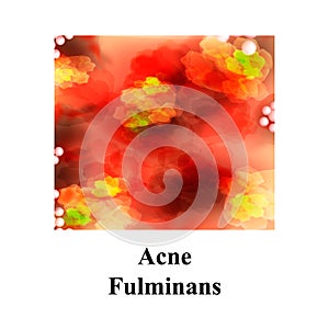 Pustules on the skin. Acne Fulminans. Cystic acne. Pimples on the skin. Furuncle. Infographics. Vector illustration.