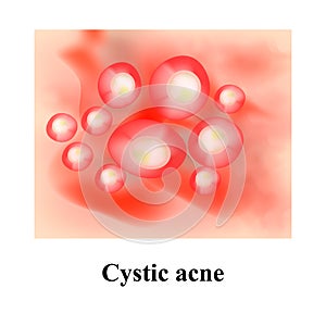 Pustules on the skin. Cystic acne. Pimples on the skin. Infographics. Vector illustration.