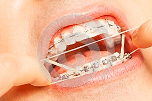 Putting orthodontic ring strings on teeth braces